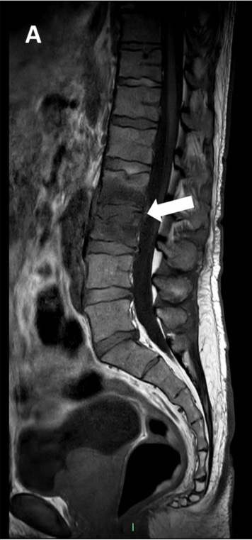 Pyogenic spondylodiscitis on sagittal MRI