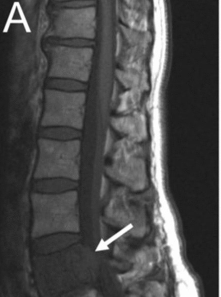 Aggressive vertebral hemangioma on sagittal MRI