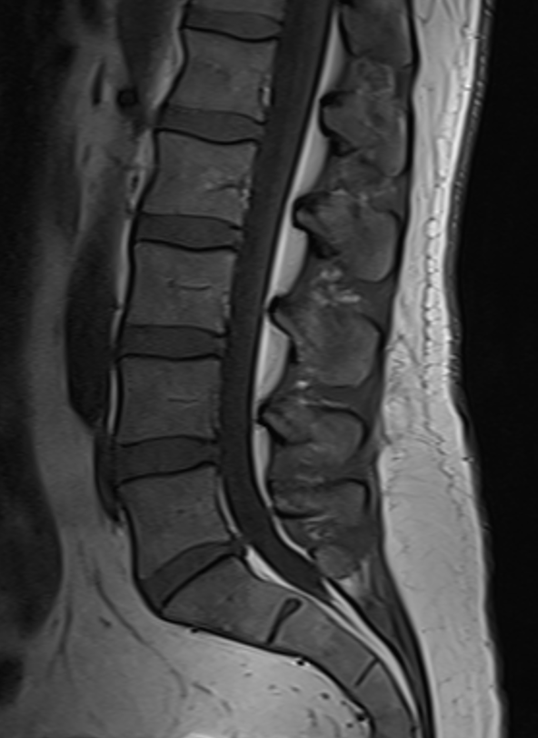 Sagittal MRI of the spine